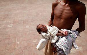 Malnutrition and stunting affect